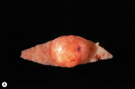 Fig. 34.4, ( A , B ) Epidermoid cyst: in this excision specimen, the punctum is clearly visible.