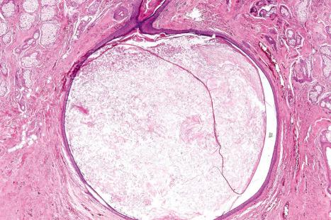 Fig. 34.5, Epidermoid cyst: a solitary lesion is present in the dermis.