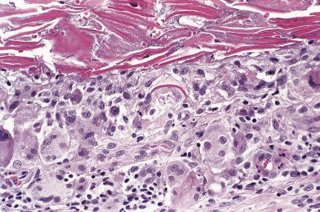 Fig. 34.7, Epidermoid cyst: rupture is associated with a foreign body granulomatous response. In the center of the field, a giant cell contains a keratin fragment.