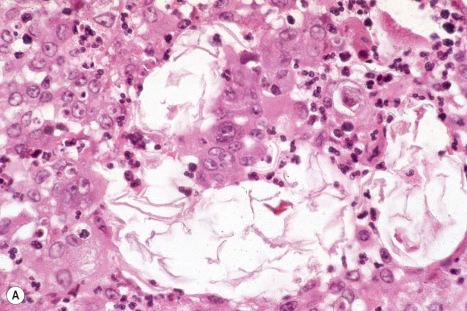 Fig. 34.8, Epidermoid cyst: ( A ) in this almost healed lesion, residual keratin lamellae, as seen in the center of the field, are all that is left of the ruptured cyst; ( B ) these may be highlighted by the Lendrum phloxine tartrazine reaction.