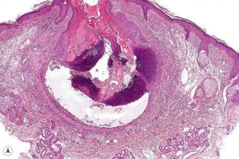 Fig. 34.9, ( A , B ) Epidermoid cyst: the lower half of the cyst wall shows matrical differentiation.