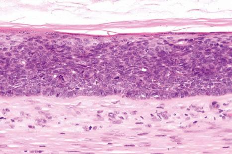 Fig. 34.10, Epidermoid cyst: in this example, the epithelial wall shows the features of carcinoma in situ.