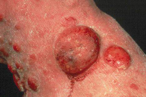 Fig. 29.1, Mycosis fungoides: this patient has advanced tumor-stage mycosis fungoides. Such massive ulcerated tumor nodules are a rare manifestation.