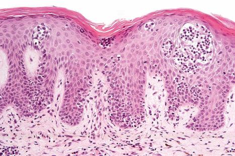 Fig. 29.101, Sézary syndrome: in this field, there are multiple Pautrier microabscesses.