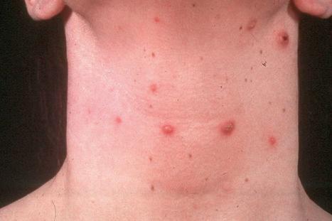 Fig. 29.104, Lymphomatoid papulosis: in this example, lesions are present on the neck.