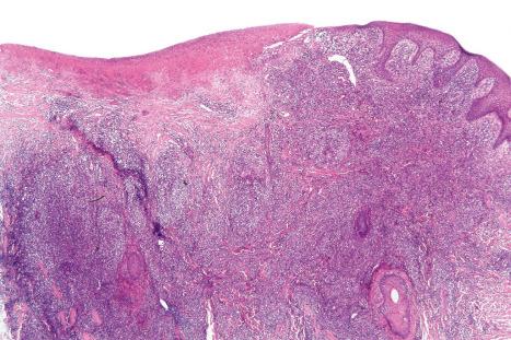 Fig. 29.105, Lymphomatoid papulosis: low-power view showing ulceration and a dense dermal infiltrate.