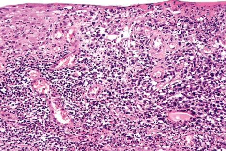 Fig. 29.106, Lymphomatoid papulosis: the epidermis is infiltrated by atypical pleomorphic lymphocytes.