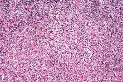 Fig. 29.107, Lymphomatoid papulosis: dense dermal infiltrate. Even at this magnification, the cytological atypia is obvious.