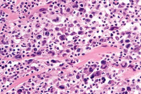 Fig. 29.108, Lymphomatoid papulosis: the lymphocytes have highly irregular hyperchromatic or vesicular nuclei. Note the background population of neutrophils.