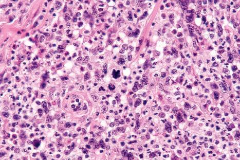 Fig. 29.109, Lymphomatoid papulosis: multiple mitotic figures are present.