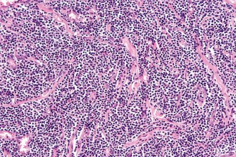 Fig. 29.111, Lymphomatoid papulosis: there is a dense infiltrate of type B cells.