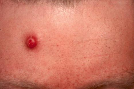 Fig. 29.114, Primary cutaneous anaplastic large cell lymphoma: erythematous, ulcerated tumor nodule on the forehead.