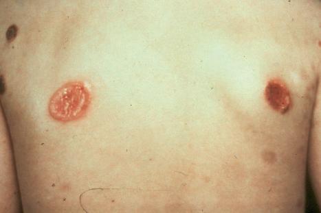 Fig. 29.116, Primary cutaneous anaplastic large cell lymphoma: multiple lesions affecting different regions are present in this patient.