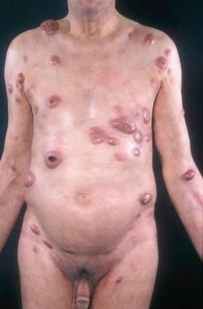 Fig. 29.12, Mycosis fungoides (tumor stage): there are multiple tumor nodules in a background of patches and plaques.