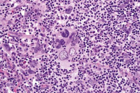 Fig. 29.122, Primary cutaneous anaplastic large cell lymphoma: note the anaplastic multinucleated tumor cells.