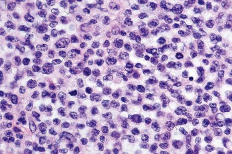 Fig. 29.126, Primary cutaneous anaplastic large cell lymphoma: small cell variant. The nuclei are darkly staining and cytoplasm is minimal.