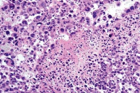 Fig. 29.128, Primary cutaneous anaplastic large cell lymphoma: widespread necrosis is present.