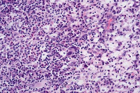 Fig. 29.129, Primary cutaneous anaplastic large cell lymphoma: abundant histiocytes as shown in this field account for misdiagnosis as inflammatory malignant fibrous histiocytoma.