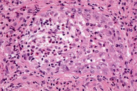 Fig. 29.130, Primary cutaneous anaplastic large cell lymphoma: numerous eosinophils are present in this example.