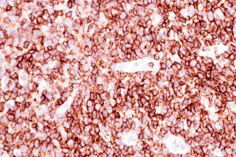 Fig. 29.132, Primary cutaneous anaplastic large cell lymphoma: the cells coexpress CD4 (same case as Fig. 29.131 ).