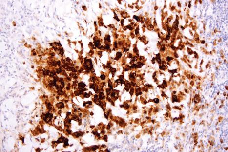 Fig. 29.133, Cutaneous anaplastic large cell lymphoma: in this example, the tumor cells express epithelial membrane antigen. This case proved to represent a metastasis from a nodal primary lesion.