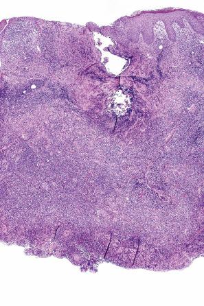 Fig. 29.134, Primary cutaneous CD4-positive small/medium T-cell lymphoproliferative disorder: this is a punch biopsy of a solitary cutaneous tumor nodule. There is a uniform infiltrate of pleomorphic lymphoid cells.