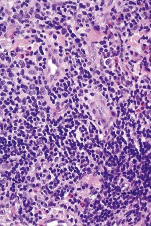 Fig. 29.135, Primary cutaneous CD4-positive small/medium T-cell lymphoproliferative disorder: the tumor cells have irregular hyperchromatic nuclei and minimal cytoplasm. Distinction from mycosis fungoides depends on clinicopathological correlation.