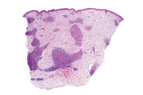 Fig. 29.143, Angioimmunoblastic T-cell lymphoma: this biopsy shows a striking granulomatous dermal infiltrate.