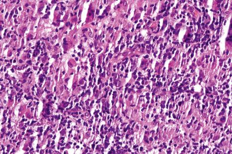 Fig. 29.144, Angioimmunoblastic T-cell lymphoma: note numerous histiocytes and scattered atypical cells.