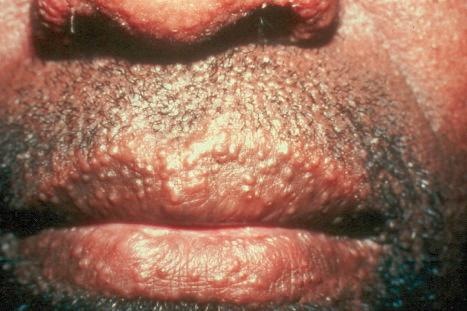 Fig. 29.145, Adult T-cell leukemia/lymphoma: in this case, multiple papules are seen on the lips.