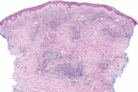 Fig. 29.147, Adult T-cell leukemia/lymphoma: there is a dense infiltrate within the dermis.