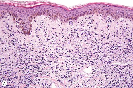 Fig. 29.148, ( A , B ) Adult T-cell leukemia/lymphoma: the infiltrate is composed of an admixture of small and large pleomorphic lymphocytes. Note the epidermotropism. Distinction from mycosis fungoides depends on clinicopathological correlation.