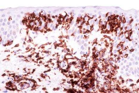 Fig. 29.149, Adult T-cell leukemia/lymphoma: the lymphocytes are CD4+ T-helper cells.