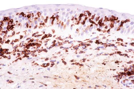 Fig. 29.150, Adult T-cell leukemia/lymphoma: there is uniform CD25 expression.