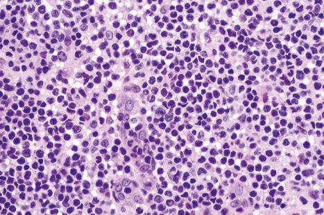 Fig. 29.15, Mycosis fungoides: the nuclei of the mycosis cells are hyperchromatic and highly irregular.