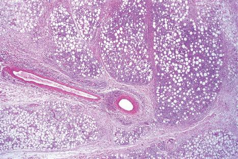 Fig. 29.153, Subcutaneous panniculitis-like T-cell lymphoma: there is a dense infiltrate in the subcutaneous fat, giving rise to a characteristic lacelike appearance.