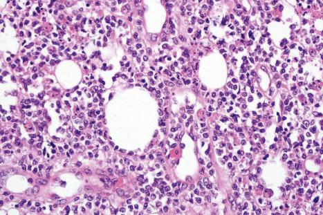 Fig. 29.154, Subcutaneous panniculitis-like T-cell lymphoma: the tumor cells have variably vesicular or hyperchromatic nuclei. Note the characteristic rimming of the adipocytes.