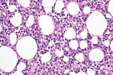 Fig. 29.155, Subcutaneous panniculitis-like T-cell lymphoma: there is an admixture of tumor cells and histiocytes.