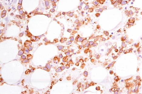 Fig. 29.157, Subcutaneous panniculitis-like T-cell lymphoma: the lymphocytes express CD3.