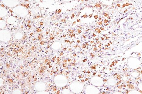 Fig. 29.158, Subcutaneous panniculitis-like T-cell lymphoma: the histiocytes are highlighted by CD68.