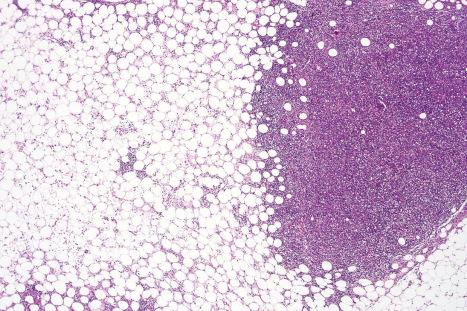 Fig. 29.159, Extranodal NK/T-cell lymphoma: this case presented with nodules in the subcutaneous fat clinically reminiscent of erythema nodosum. There is extensive infiltration of the dermis and subcutaneous fat by atypical lymphocytes.