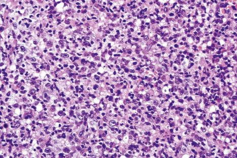 Fig. 29.162, Extranodal NK/T-cell lymphoma: the tumor cells have large vesicular nuclei with prominent nucleoli.