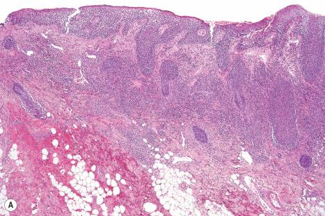 Fig. 29.164, ( A , B ) Primary cutaneous CD8+ aggressive epidermotropic T-cell lymphoma: there is a dense superficial perivascular and bandlike upper dermal infiltrate with marked epidermotropism.