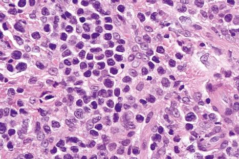 Fig. 29.165, Primary cutaneous CD8+ aggressive epidermotropic T-cell lymphoma: the lymphocytes have enlarged, irregular hyperchromatic nuclei.