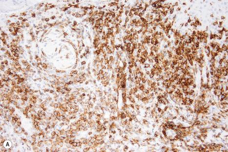 Fig. 29.166, ( A , B ) Primary cutaneous CD8+ aggressive epidermotropic T-cell lymphoma: ( A ) the lymphocytes express CD8; ( B ) TIA1 is positive.