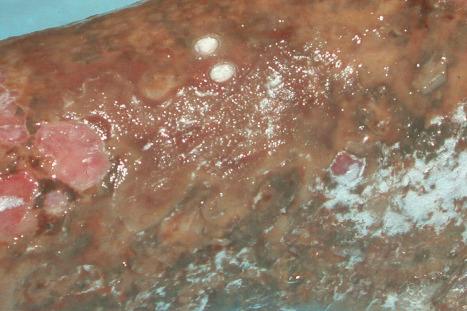 Fig. 29.167, Primary cutaneous gamma/delta T-cell lymphoma: this patient has extensively ulcerated lesions.