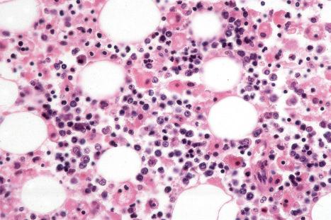 Fig. 29.170, Primary cutaneous gamma/delta T-cell lymphoma: this field shows marked erythrophagocytosis.