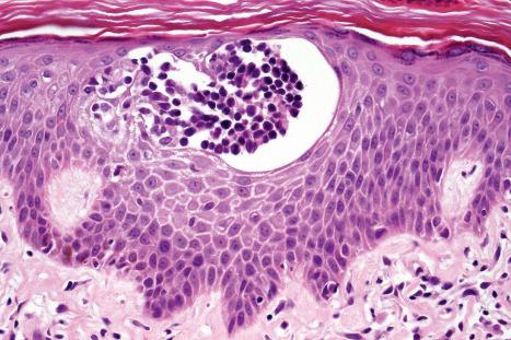 Fig. 29.17, Mycosis fungoides: a typical Pautrier microabscess composed of hyperchromatic atypical lymphocytes.