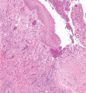 Fig. 29.171, Intravascular pseudo-T-cell lymphoma: numerous dilated lymphatic channels containing blastic lymphoid cells.