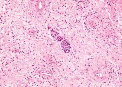 Fig. 29.172, Intravascular pseudo-T-cell lymphoma: closer view of a dilated lymphatic vessel containing blastic lymphoid cells.